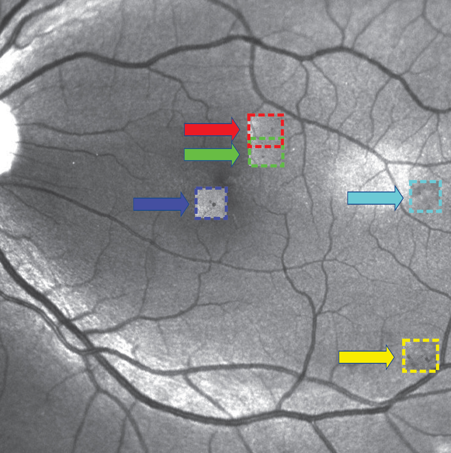 image of Retinal microaneurysm