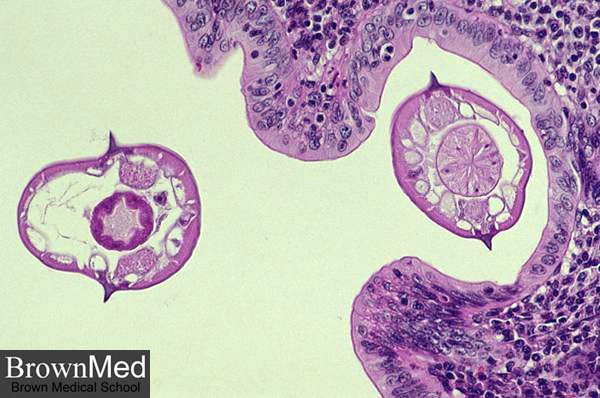 enterobius vermicularis petesejt vastagbélrák nő tünetei