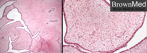 phyllodes tumor growth rate