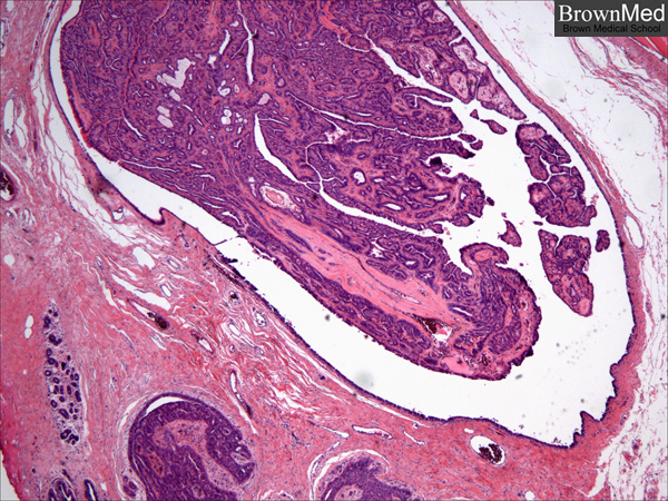 intraductal papilloma histo)