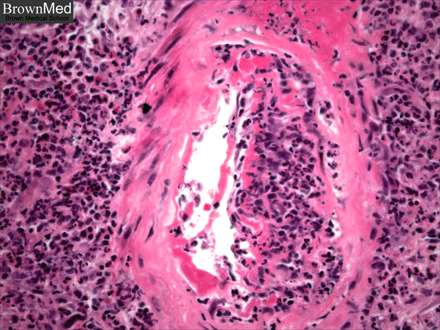 polyarteritis #10