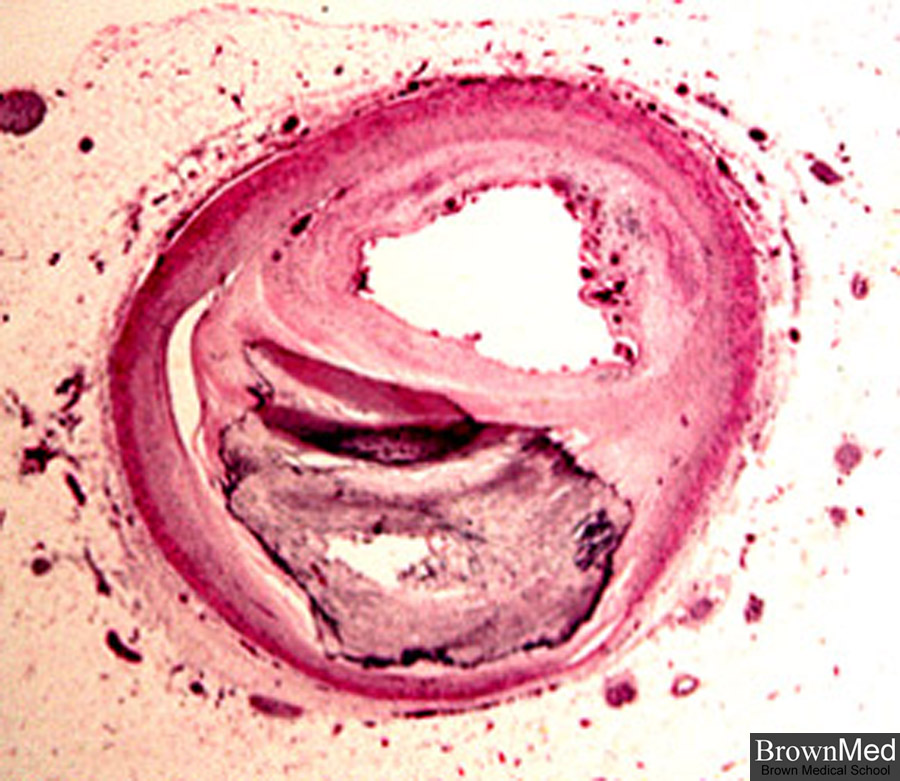 Artery atherosclerosis coronary Arteriosclerosis /