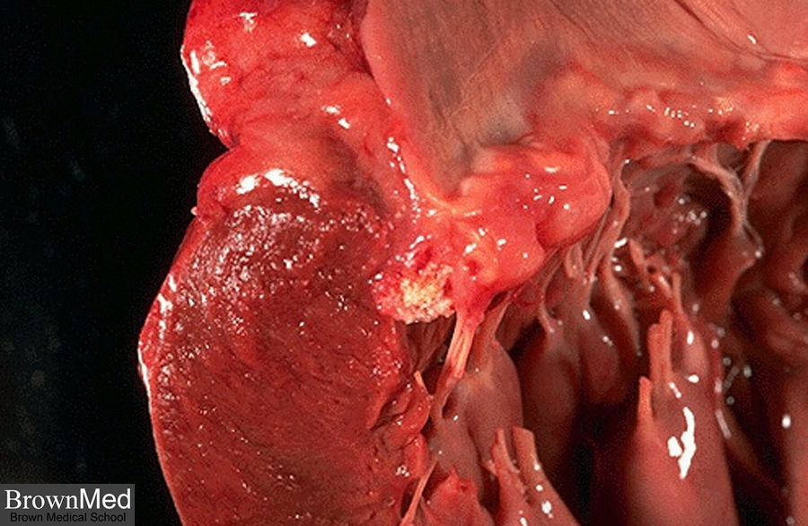 Mitral valve (annular calcification). An illustration of mitral annular 