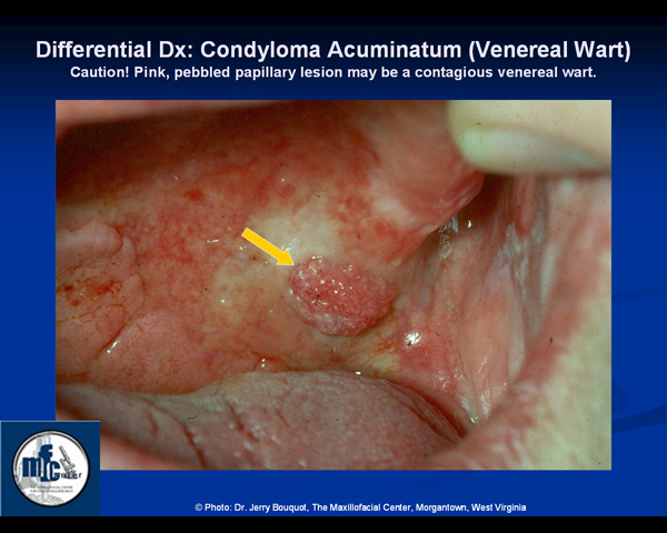 leukoplakia condilom