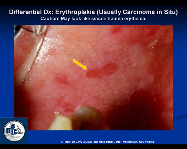 Erythroplakia Pathology Residency And Fellowship Program Brown