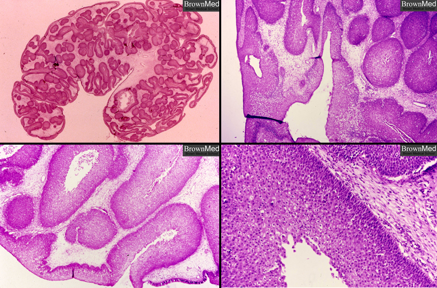 inverted sinonasal papilloma pathology