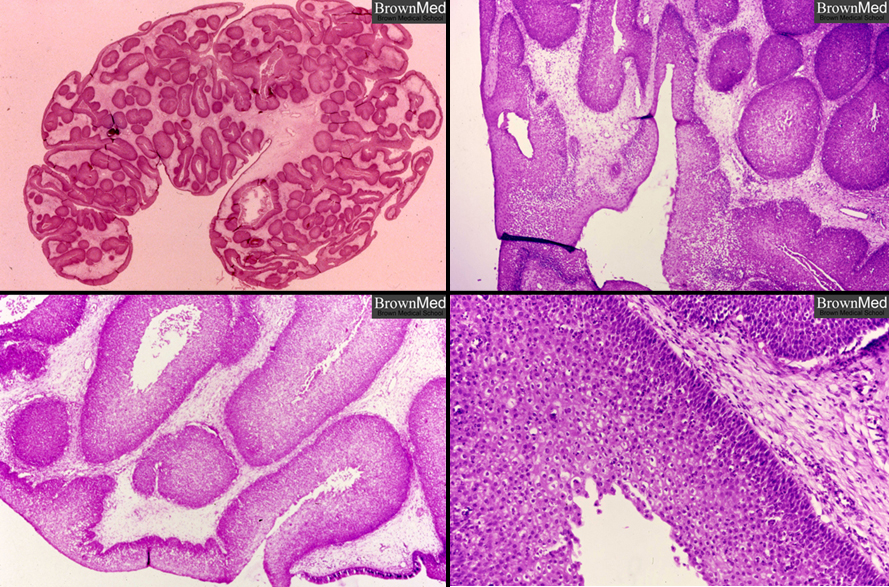 inverted papilloma malignant degeneration)