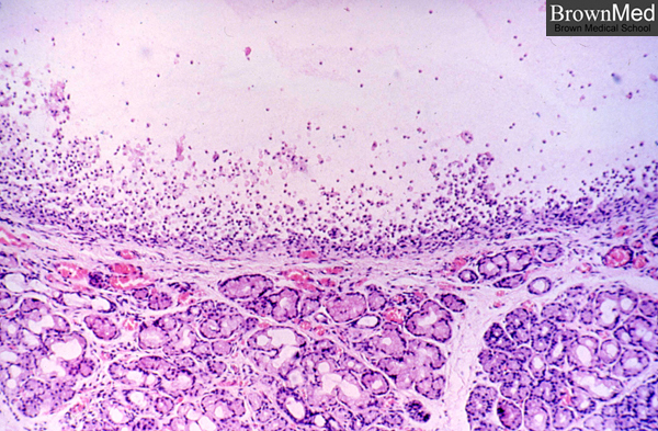 Office Management of Digital Mucous Cysts - American ...