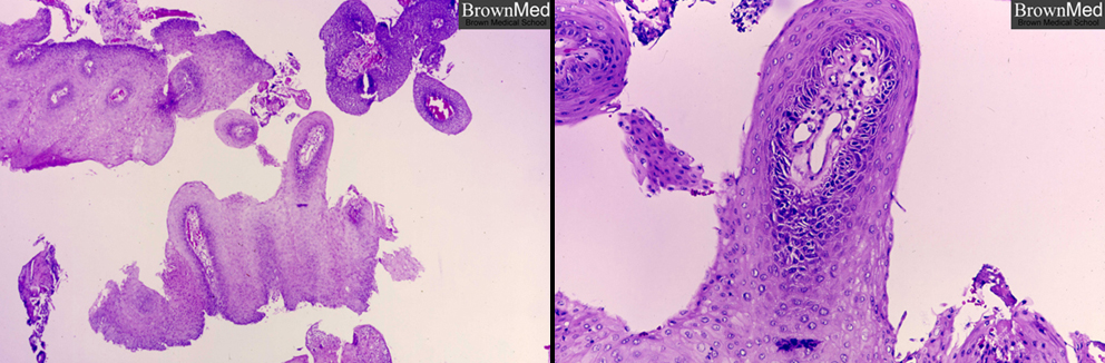 laryngeal papilloma histopathology