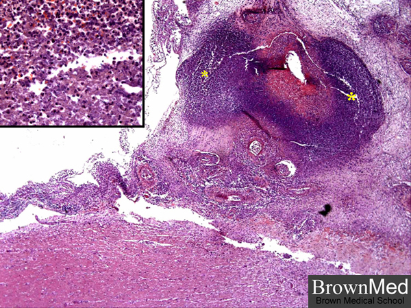 Bacterial meningitis. There is an intense acute inflammatory infiltrate in 