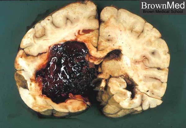 brain hemorrhage pictures