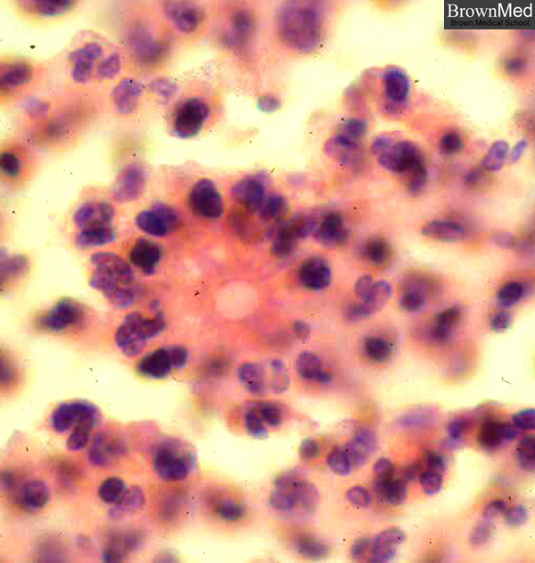 sporotrichosis #10