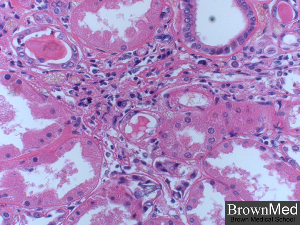 chronic pyelonephritis