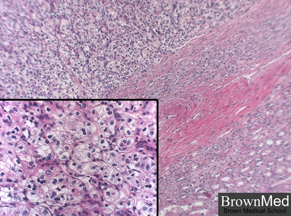 Renal cell carcinoma was formerly known as hypernephroma and is also called 