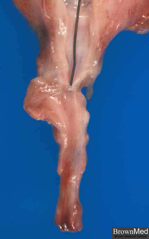 Posterior Urethral Valves. Posterior urethral valve