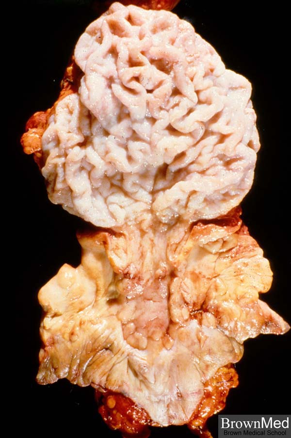 condyloma acuminatum vulva patológia körvonalazódik)