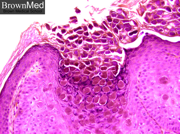 molloscum contagiosum #10