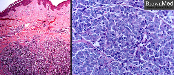 Merkel Cell Carcinoma