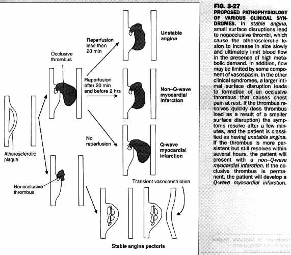 Myocardial Infarction Pathophysiology Flow Chart