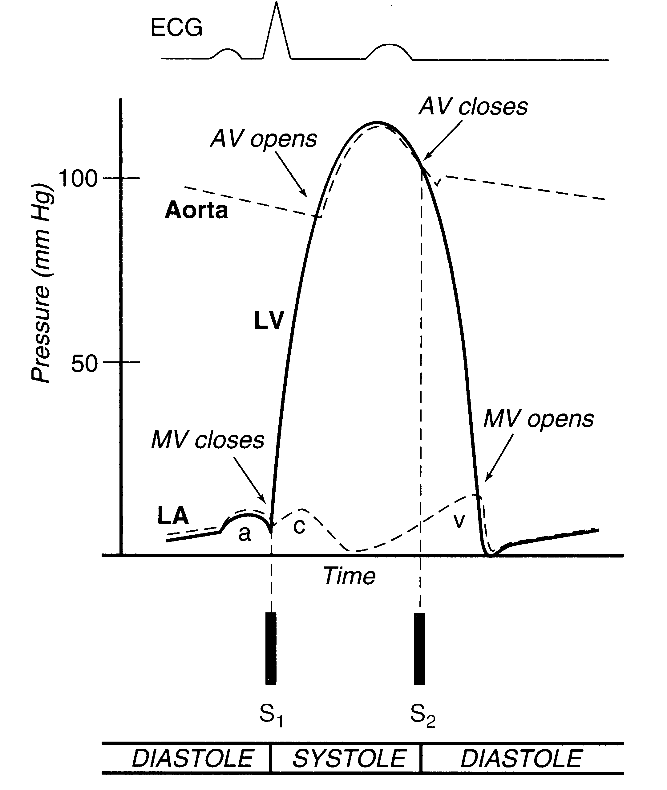 Congestive Heart Failure Stages Chart