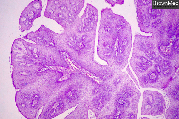 histopathology of papilloma