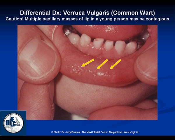 Squamous papilloma vs verruca vulgaris