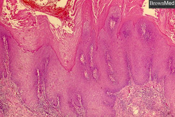 Pdf Multi Centricity Of Oral Verrucous Carcinoma