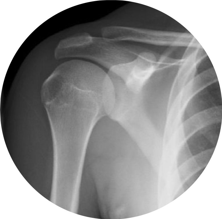 Shoulder