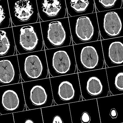 Neurocritical Care