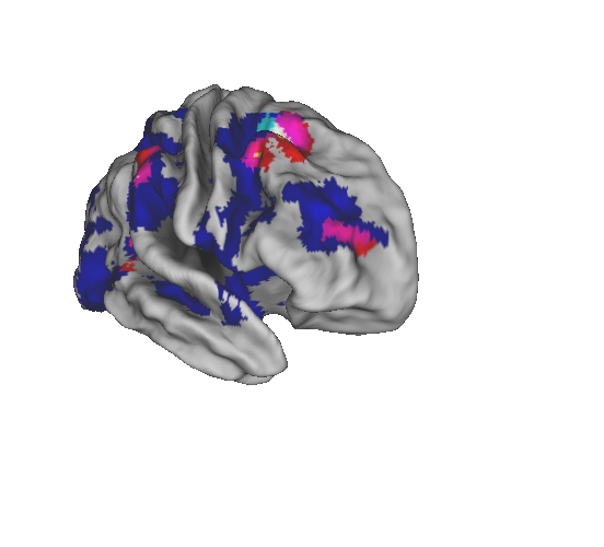 NPH Brain Images_Cerebrospinal Fluid Project.jpg