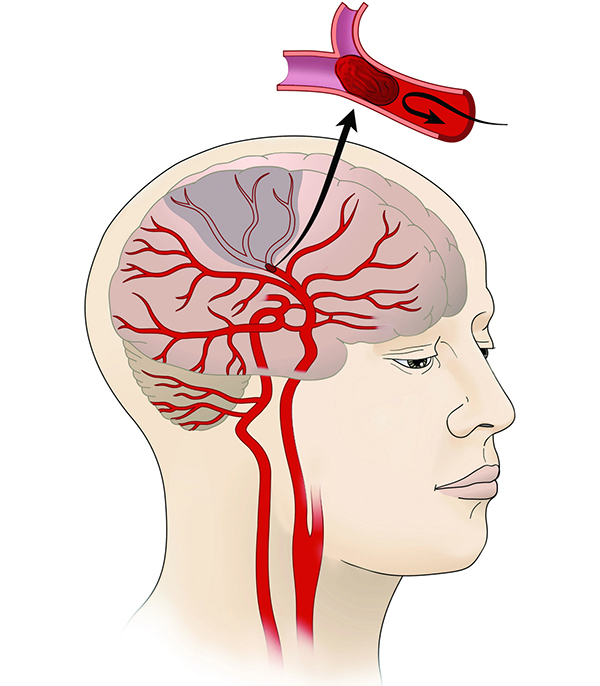 Diagram of a stroke in the human brain