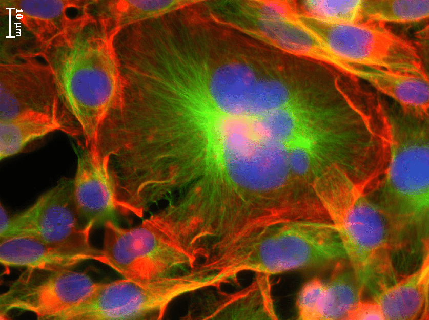 Brightly colored cancer cells