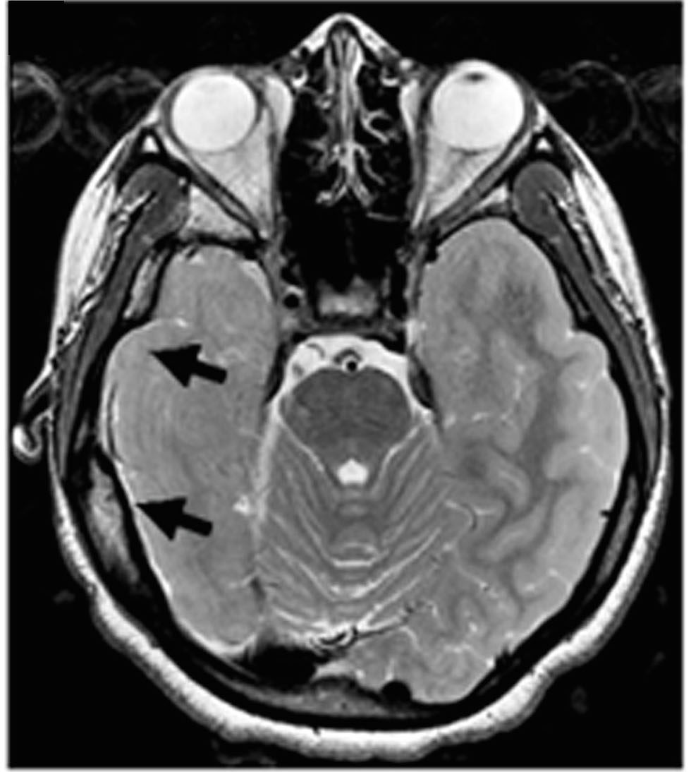 Epileptic brain x-ray 