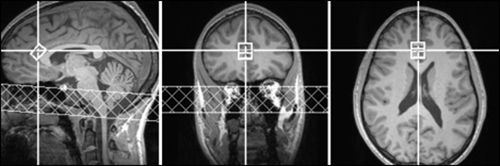 Series of brain scans