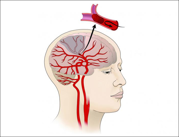 Illustration of a stroke