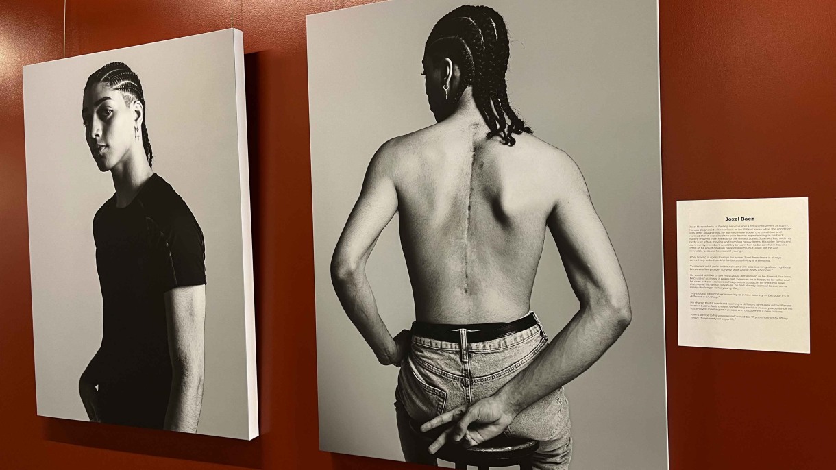 Exhibition at Brown’s medical school offers multi-faceted view of patients with scoliosis