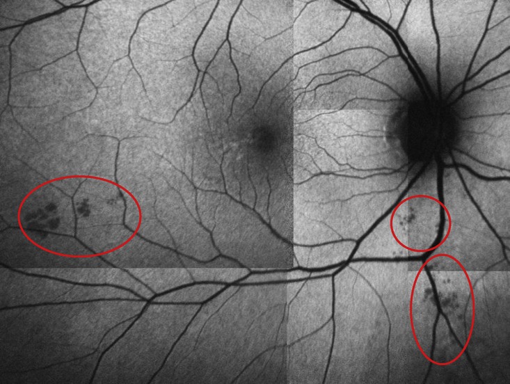 Amyloid plaque in retinal scan