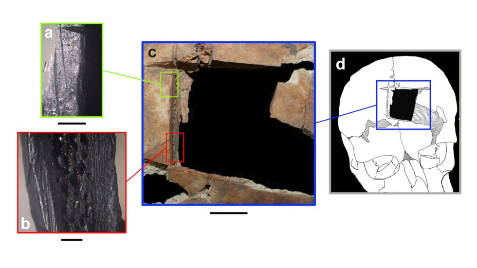 photos of a hole in a skull and a drawing showing where the hole is located