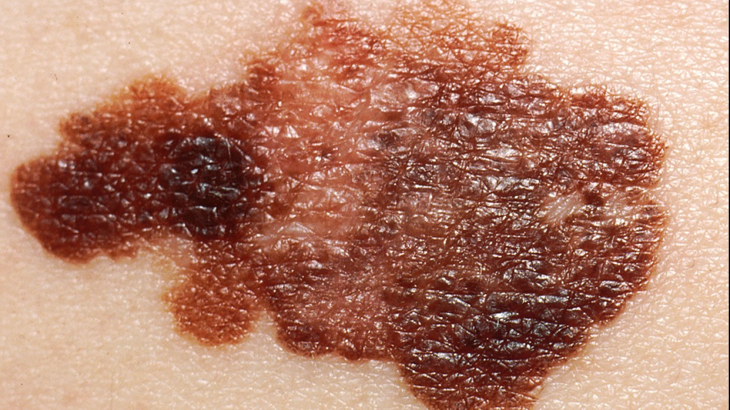 Study finds no substantial harm from primary care melanoma screening |  Brown University