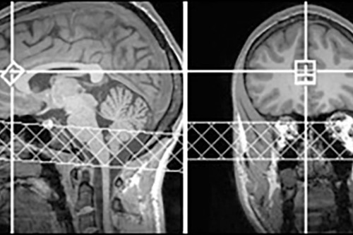 Adhd Drugs Increase Brain Glutamate >> Adhd Drugs Increase Brain Glutamate Predict Positive Emotion In Adhd Drugs Increase Brain Glutamate >> Adhd Drugs Increase Brain Glutamate Predict Positive Emotion In