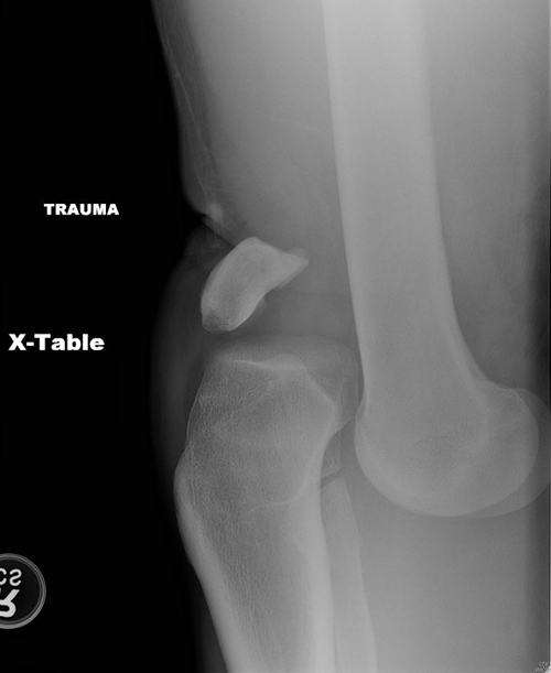 X-ray of dislocated knee